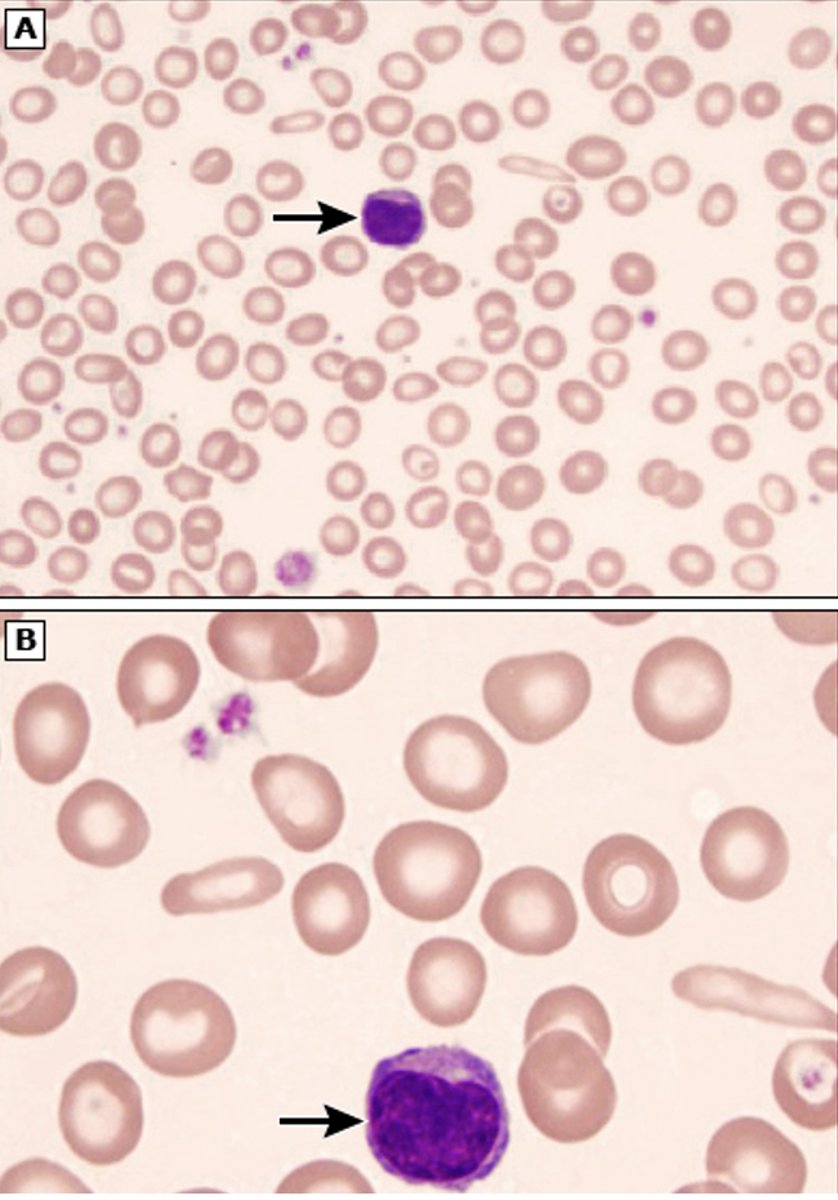 <p>- Microcytic (small) red blood cells</p><p>- Hypochromic (pink not red) RBC</p><p>- Anisocytosis (increased RDW)</p><p>- Target cells</p>