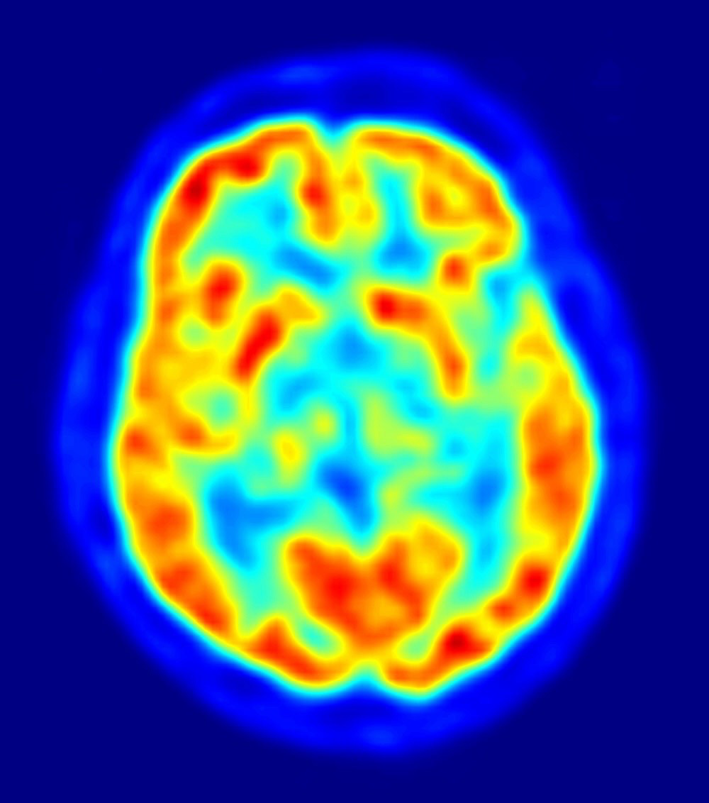 <p>What is PET and what does it measure?</p>