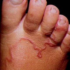 <p>- Partially, instead they migrate subcutaneously known as the serpiginous tunnel. The parasite's life cycle cannot be completed since they are in the wrong host.</p><p>- Puritis, inflammation, 2ndary bacterial infection, possible loss of toes, and hypersensitivity/allergic reaction</p>