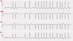 <p>- sinus bradycardia</p><p>- sinus pauses/arrest</p><p>- tachy-brady syndrome</p><p>- chronotropic incompetence (inadequate HR increase with activity)</p>