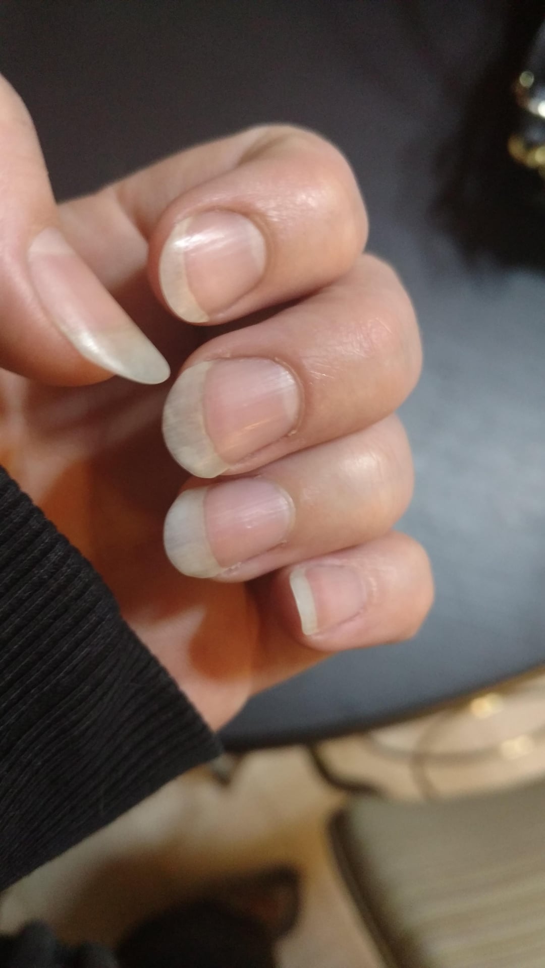 <p>what nail condition is this?</p>