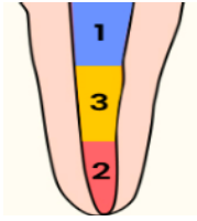 <p>use of hand and rotary</p><p>step back step down combination procedure</p><p>Involves <strong>combination crown down and step- back </strong>techniques. Starts preparing the coronal then apical then fuse the two creating a smooth taper.</p><p>coronal instrumentation with reaming motion and apical instrumentation with circumferential filing</p>