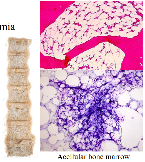 <p>Aplastic Anaemia</p>