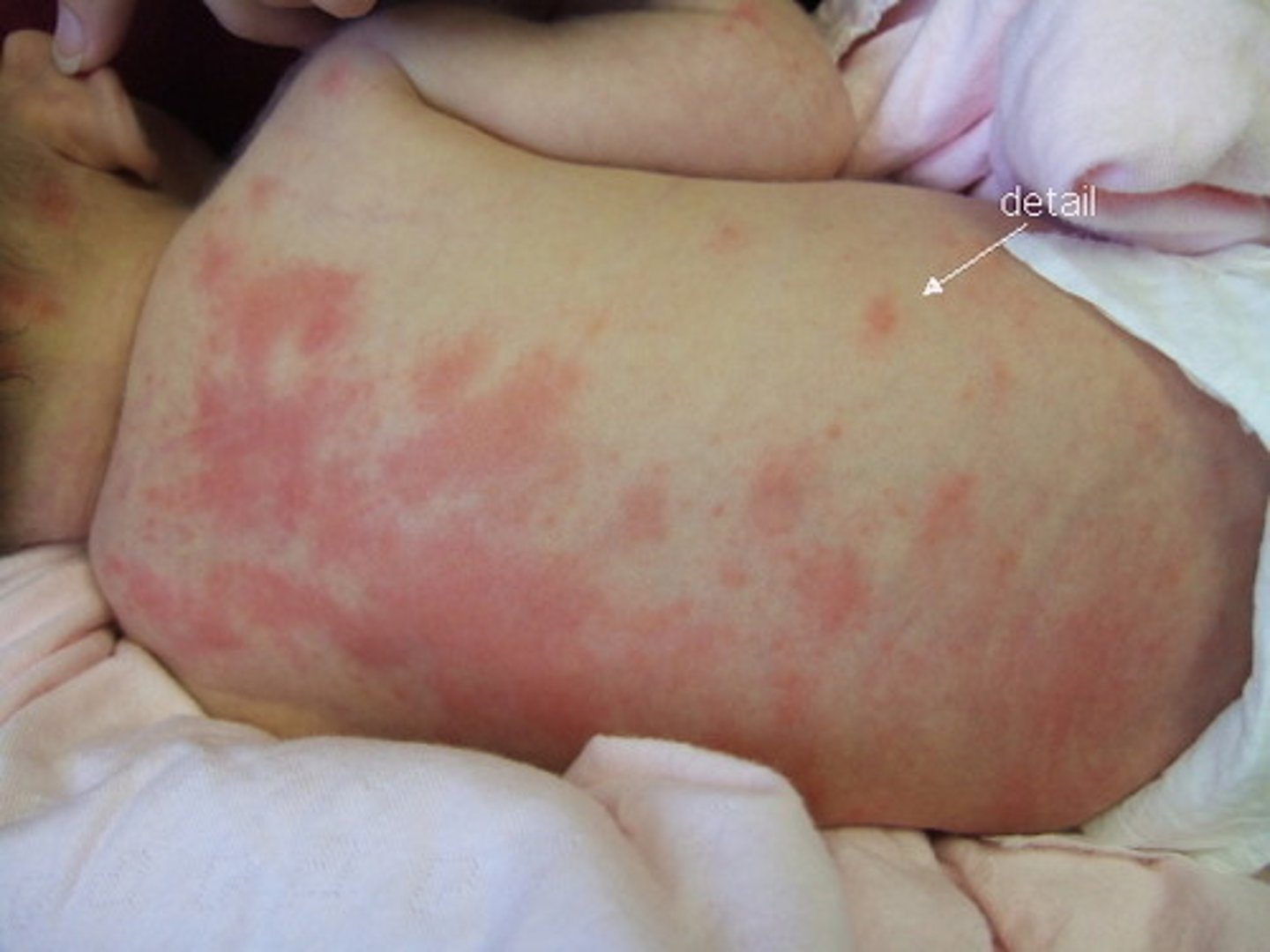 <p>1-2mm white papules on erythematous base, filled with eosinophils, on body</p>