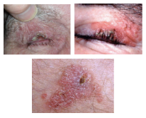<p>What is the most likely diagnosis ?</p>