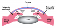<p>Sudden obstruction of flow of aqueous fluid into anterior chamber</p><p>Emergency!! permanent vision loss if untreated</p><p>quick pupil dilation can trigger it</p>