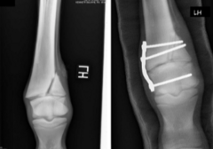 <p>Which Salter-Harris fracture type is shown?</p>