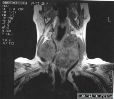 <p><strong>Thyroid Goiter</strong></p>