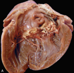 <p>Which type of thrombus is</p><p>represented in this image?</p><p>What type of emboli is most</p><p>likely associated with it?</p>