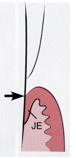 <p>stage of passive eruption: Both the base of the sulcus and the epithelial attachment are on the surface of the cementum</p>