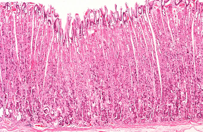<p>hyperplasia of parietal cells is noted in what </p>