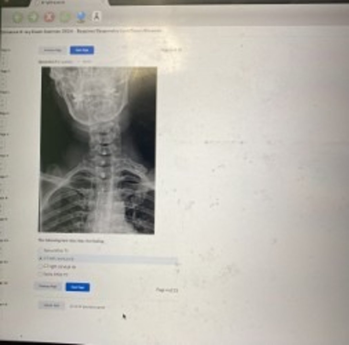 <p>C7 left cervical rib</p>