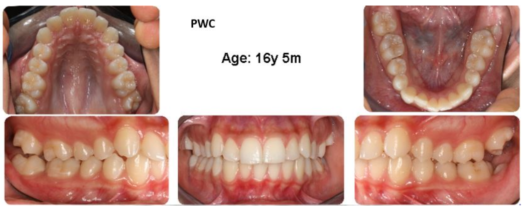 <p><span>What is the Angle's classification for this patient?</span></p>