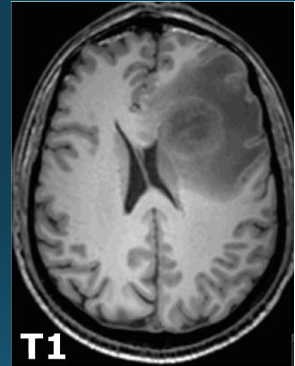 <p>MRI T1 weighted images</p>