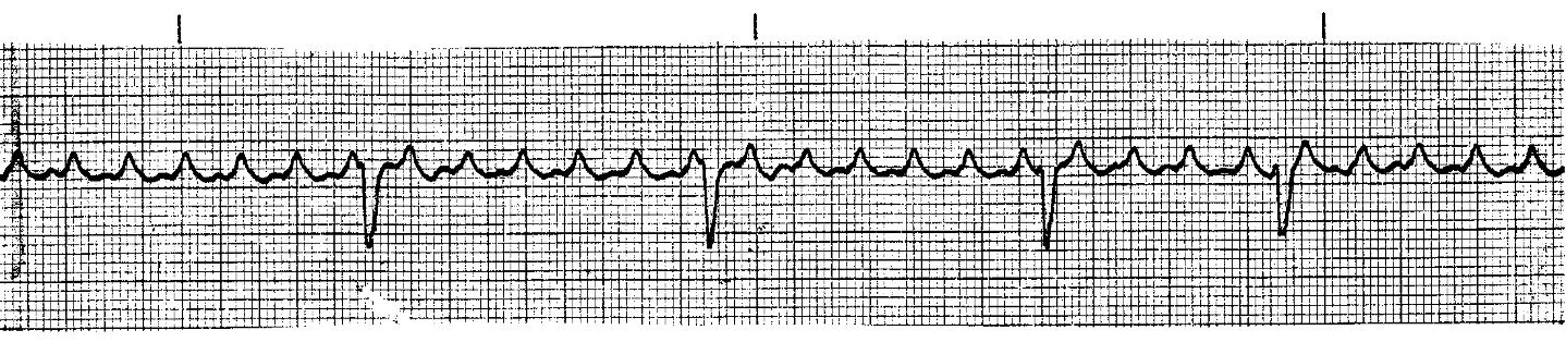 <p>What ECG is this? </p>