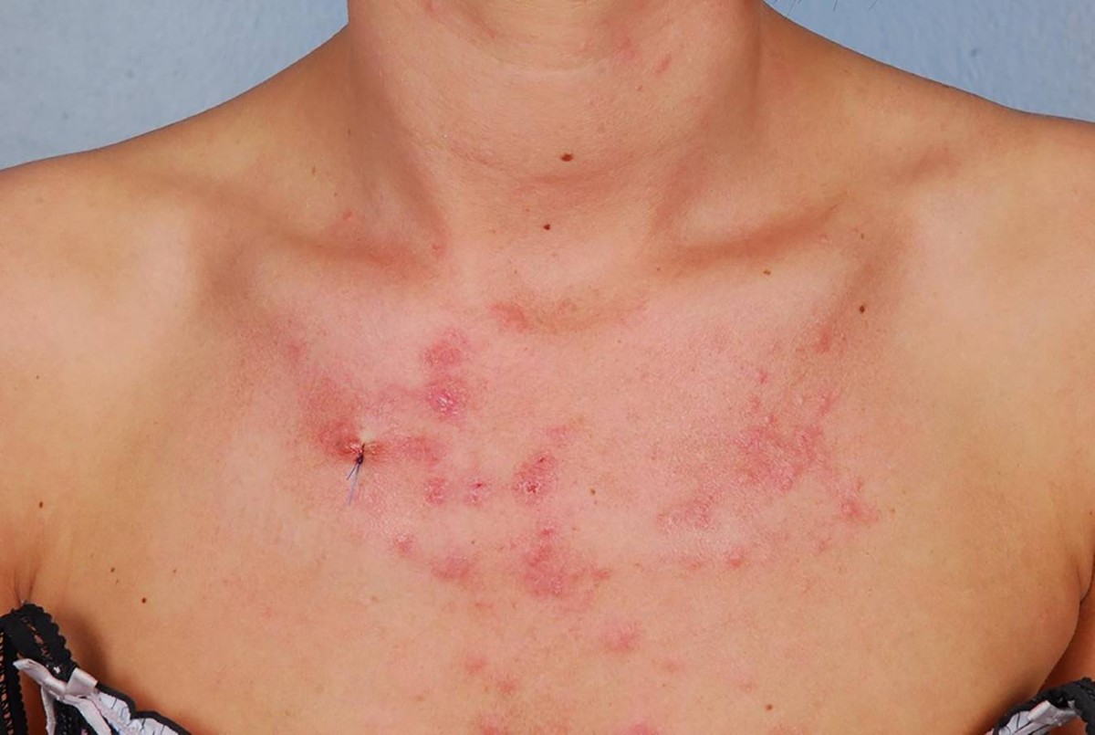 <p>Sonnenallergie (polymorphe Lichtdermatose)</p>