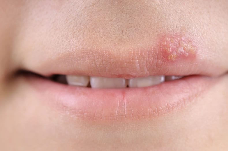 <p><span style="background-color: transparent; font-family: "Times New Roman", serif;">A communicable virus that appears as a vesicle on the lip similar to a blister. Find more information in the chapter on diseases and disorders of the skin.</span></p>