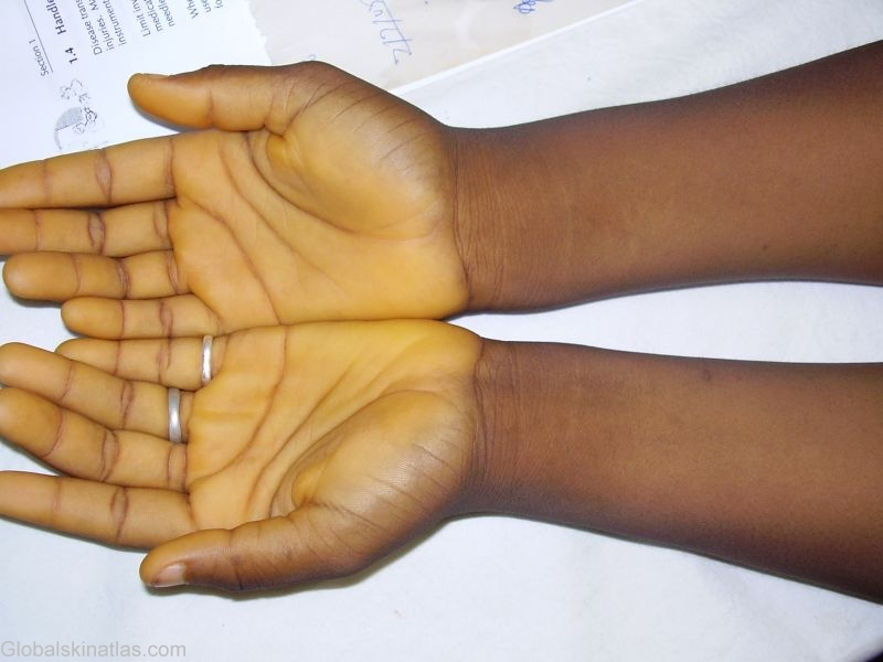 <p>Yellowing of skin due to increased dietary intake of carotene</p><p>Foods: carrots, sweet potatoes, pumpkin, corn, yams, spinach, beans</p><p>Sclera does NOT become yellow</p>