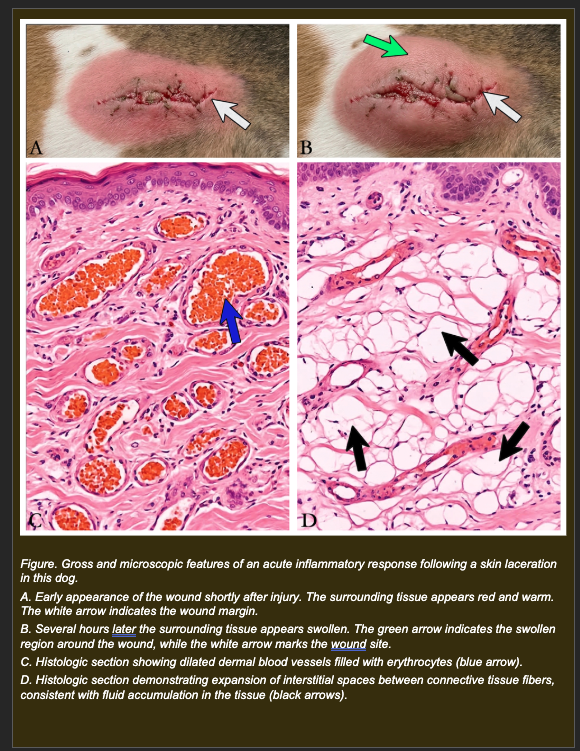 <p>A dog sustains a contaminated skin laceration. Within minutes the wound margins become bright red and warm. Two hours later the surrounding tissue is visibly swollen.</p><p>Histologic examination shows:</p><p>- Dilated dermal blood vessels filled with erythrocytes (Panel C)</p><p>- Expansion of interstitial spaces between connective tissue fibers consistent with fluid accumulation (Panel D)</p><p>- Early neutrophil presence at the vessel margins</p><p></p><p><strong>Which explanation most accurately accounts for both the early redness/warmth AND the later swelling -- using the vascular event sequence of acute inflammation?</strong></p><p>a. Venous obstruction traps blood producing redness, while increased arterial inflow expands tissue producing swelling</p><p>b. Arteriolar dilation increases blood flow producing active hyperemia (redness and warmth); inflammatory mediators then increase vascular permeability allowing protein-rich fluid to exit vessels into tissue producing edema (swelling)</p><p>c. Lymphatic obstruction prevents fluid drainage producing redness, while leukocyte accumulation within tissue produces swelling by increasing tissue mass</p><p>d. Tissue hypoxia from reduced arterial perfusion causes cell death producing redness; the resulting necrotic debris accumulates causing swelling</p>