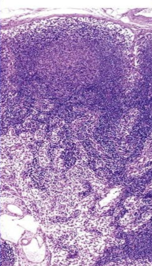 <p>What is the light round area in the top area of this lymph node?</p>