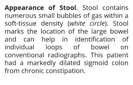 <p>Appearance of stool</p>