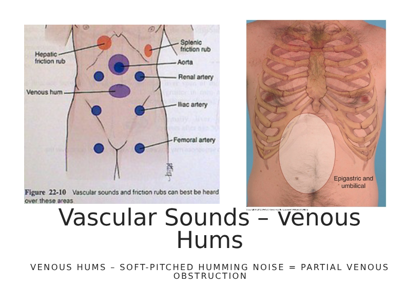 <p>venous hums- soft pitched hum, partial obstruction vessel- reduced flow to organ </p>
