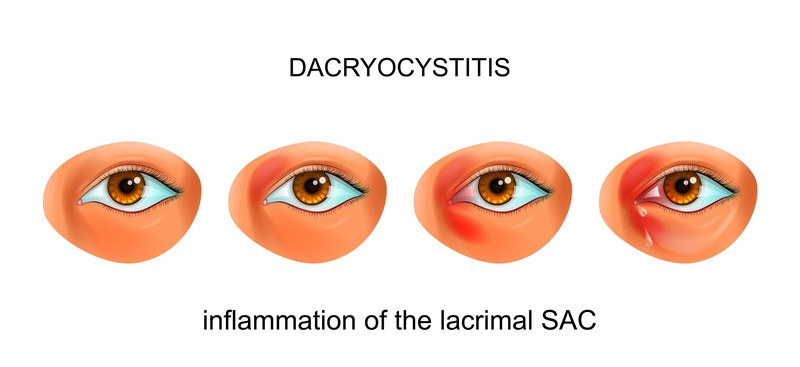 <p>PP: inflammation of lacrimal sac</p><p>E: bx infxn<br>nasolacrimal duct obstruction<br>tumor</p><p>TX: warm compress<br>abx</p>