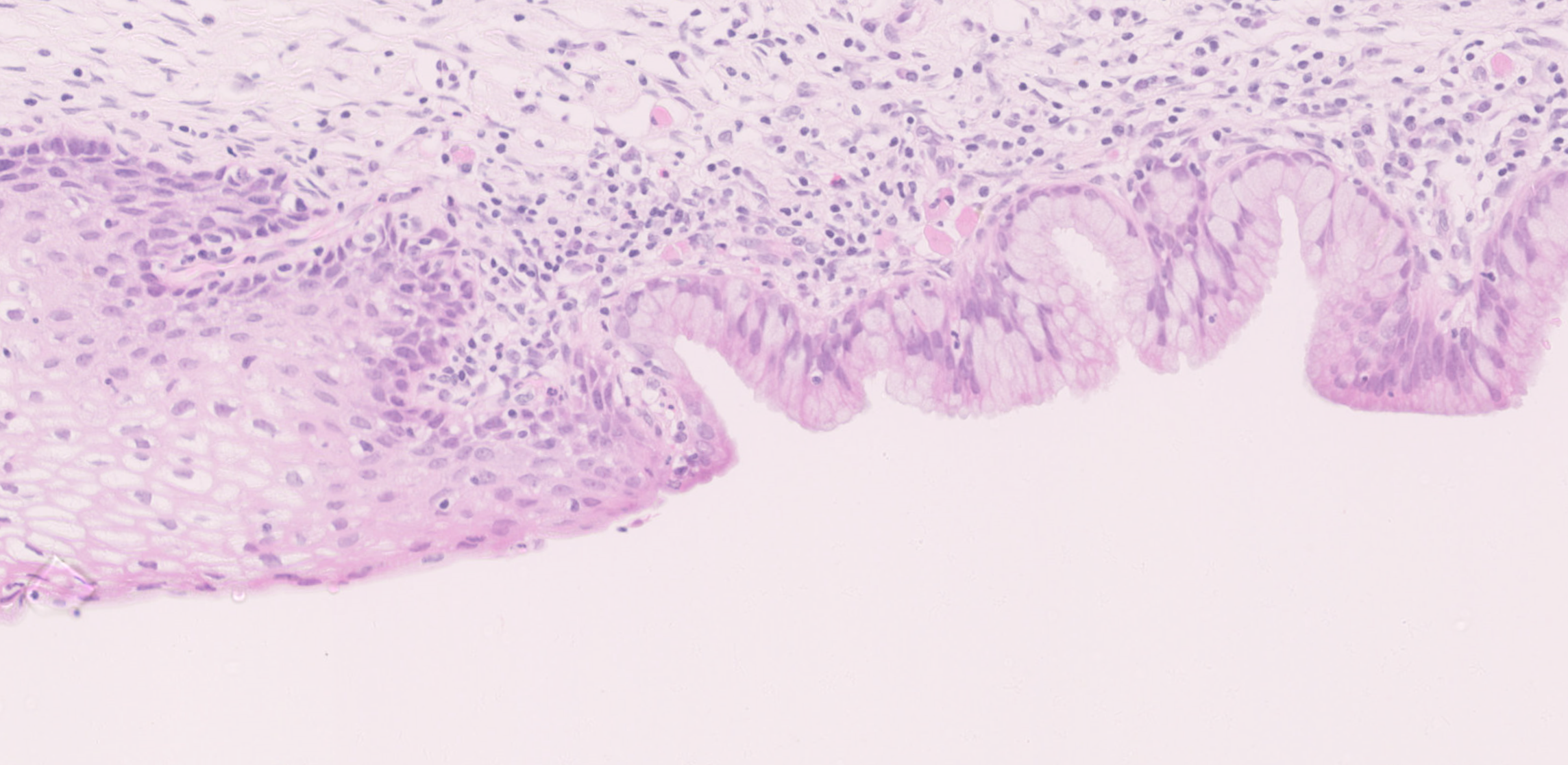 <p>squamo-columnar junction (SCJ)  </p>