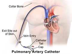 <p>Neck, inserted into jugular vein</p>