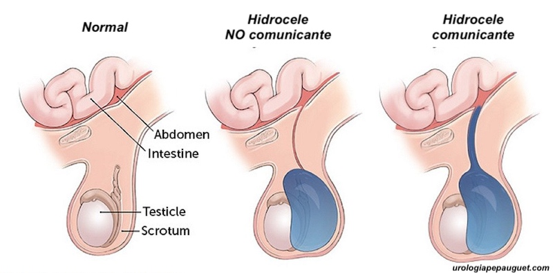 <p>Acumulación de líquido alrededor del testículo</p><ul><li><p><strong>Comunicante:</strong> CPV permeable en todo su trayecto pero con un diámetro muy pequeño que solo deja salir líquido abdominal al escroto. Aumenta en el día y se reintroduce en la noche.</p></li><li><p><strong>No comunicante:</strong> El canal está cerrado, dejando el líquido atrapado en el escroto. Su tamaño es constante y suele desaparecer por sí solo durante el primer año de vida.</p></li></ul><p></p>