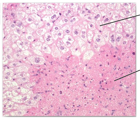 <p>Is this the microscopic appearance of cells that have undergone cellular degeneration, cell death or cell adaption? <em>The bottom and top half have different answers.</em></p>