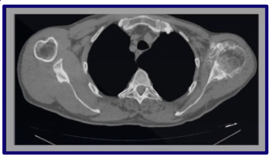 <p>Cortical bone and cancellous bone</p>