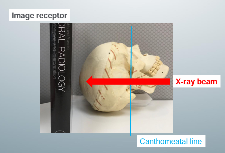 <p>-image receptor placed parallel to pt’s transverse plane and perpendicular to the midsagittal and coronal planes</p><p>-pt needs to extend neck as far back as possible such that the canthomeatal line could form a 10 degree angle with image receptor</p><p>-central x-ray beam position directed below the mandible toward the vertex of the skull and centered to 2cm anterior to a line connecting the right and left mandibular condyles</p>