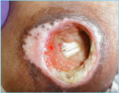 <p>Full thickness skin loss, exposed bone, tendon, or muscle, slough or eschar, and tunneling</p>