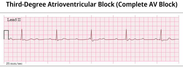 <p>What type of AV block is being described? </p><p>-Complete failure of conduction from atria to ventricles, where the P waves and QRS complexes march independently (Ps and Qs don’t agree) </p><p>-Tx: transcutaenous pacing immediately if unstable, permanent pacemaker required </p>
