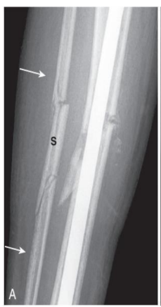 <p>type of fracture</p>