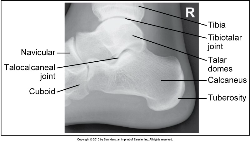 <p>lateral calcaneus</p>