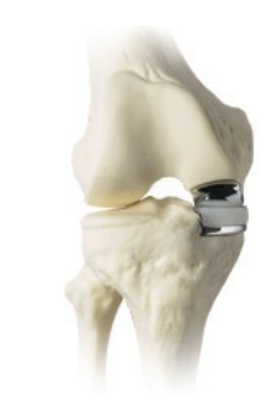 <ul><li><p>used for isolated medial </p></li><li><p>> lateral compartment disease</p></li><li><p>all ligaments must be intact </p></li><li><p><8% of all arthroplasties </p></li><li><p>good candidates are normal weight, elderly </p></li></ul><p></p>