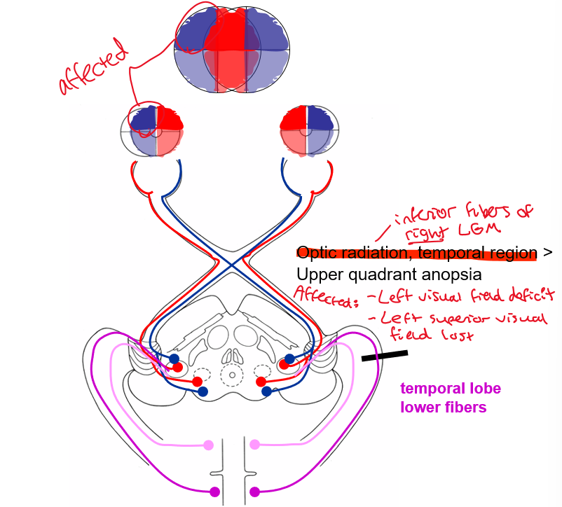 <p>Left superior visual field lost</p>