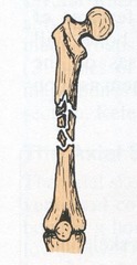 <p>- bone is splintered into several small pieces between main parts</p>
