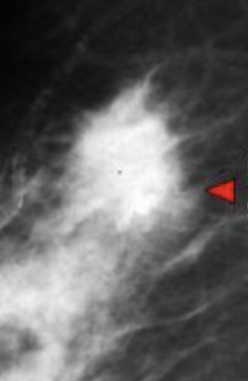 <ul><li><p>Likely malignant </p></li><li><p>Defined spiculated mass </p></li><li><p>Dense </p></li></ul><p></p>