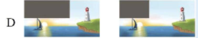 <p><strong>Interruption of portion of geniculocalcarine fibers</strong></p><p></p>