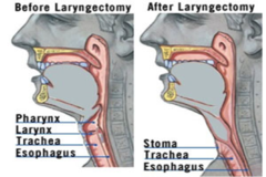 <p>Removal of the Larynx</p>