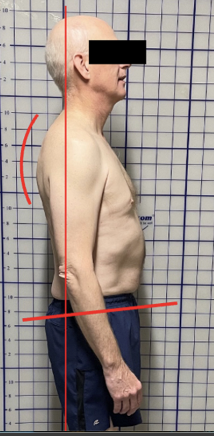 <p>Posterior pelvic tilt: why?</p>