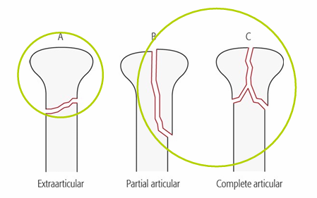 <p><strong>Extra</strong>‑articular (A), <strong>Partial </strong>articular (B), <strong>Complete </strong>articular (C)</p>