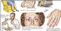 <p>Polymyositis</p>