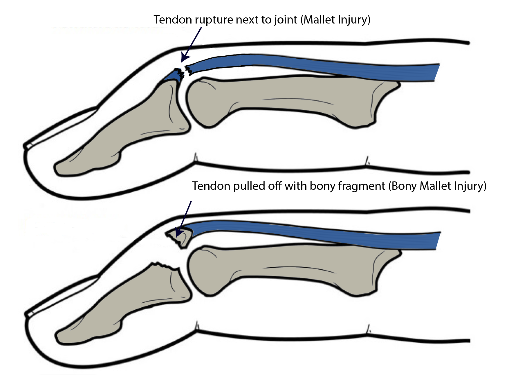 <p>Distal to or @ DIP joint</p><ul><li><p><strong>MOI:</strong> direct trauma to fingertip, causing abrupt, forceful DIP joint flexion</p></li><li><p><strong>Soft mallet:</strong> terminal tendon tear</p></li><li><p><strong>Bony mallet:</strong> terminal tendon tear associated w/ avulsion fracture </p></li></ul><p></p>