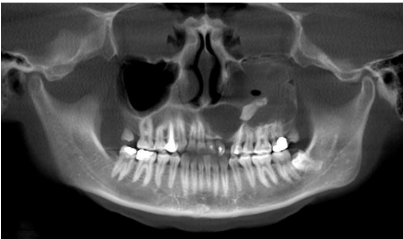 <p>A 25 year old patient present with mild swelling of front jaw. Intra orally a small swelling was visible and 23 was missing. A radiograph taken. Provide Differential diagnosis</p>