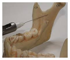 <p></p><p>What landmarks are anesthetized with an inferior alveolar block?</p><p>teeth</p>