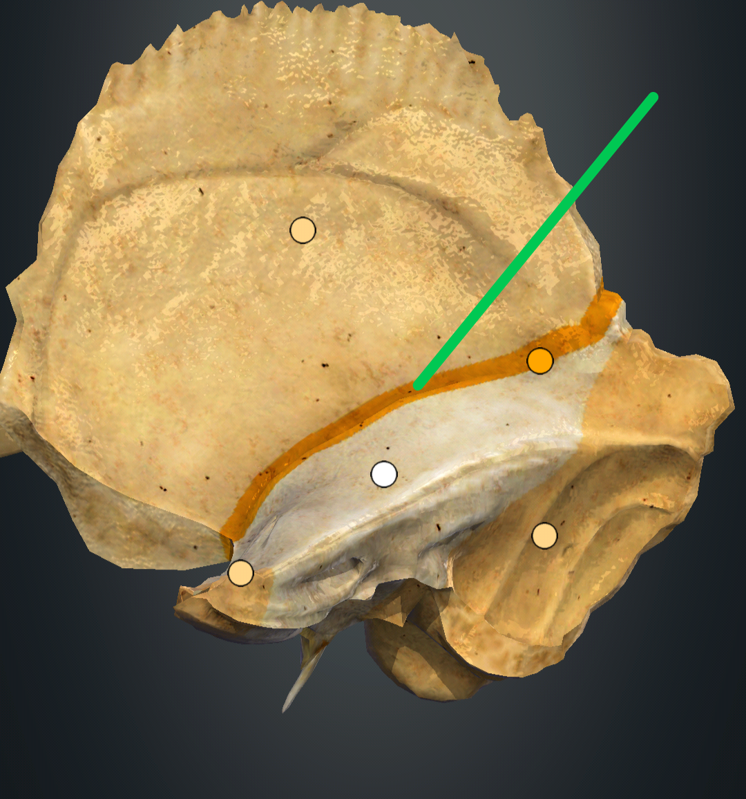 <p>fissura petrosquamosa</p>